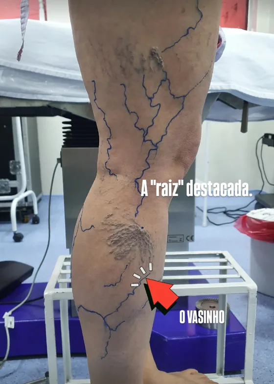 Antes: perna com a veia responsável pelos vasinhos marcada